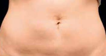 Cryolipolyse