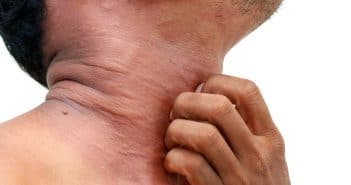 Lasek Duriez A Auteur A Realites Therapeutiques En Dermato Venerologie