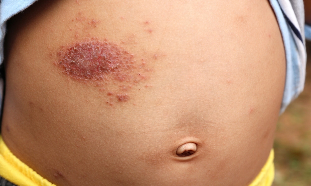 Le Psoriasis De L Enfant A T On Revolutionne La Prise En Charge Realites Therapeutiques En Dermato Venerologie Le Psoriasis De L Enfant A T On Revolutionne La Prise En Charge Realites Therapeutiques En Dermato Venerologie