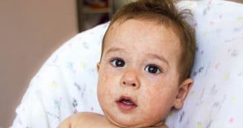 Pourquoi la prévalence des allergies alimentaires a-t-elle augmenté chez l’enfant et comment prévenir cette évolution ?
