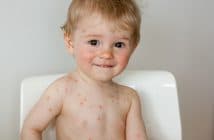 Pelade De L Enfant Comment La Prendre En Charge Realites Therapeutiques En Dermato Venerologie Pelade De L Enfant Comment La Prendre En Charge Realites Therapeutiques En Dermato Venerologie