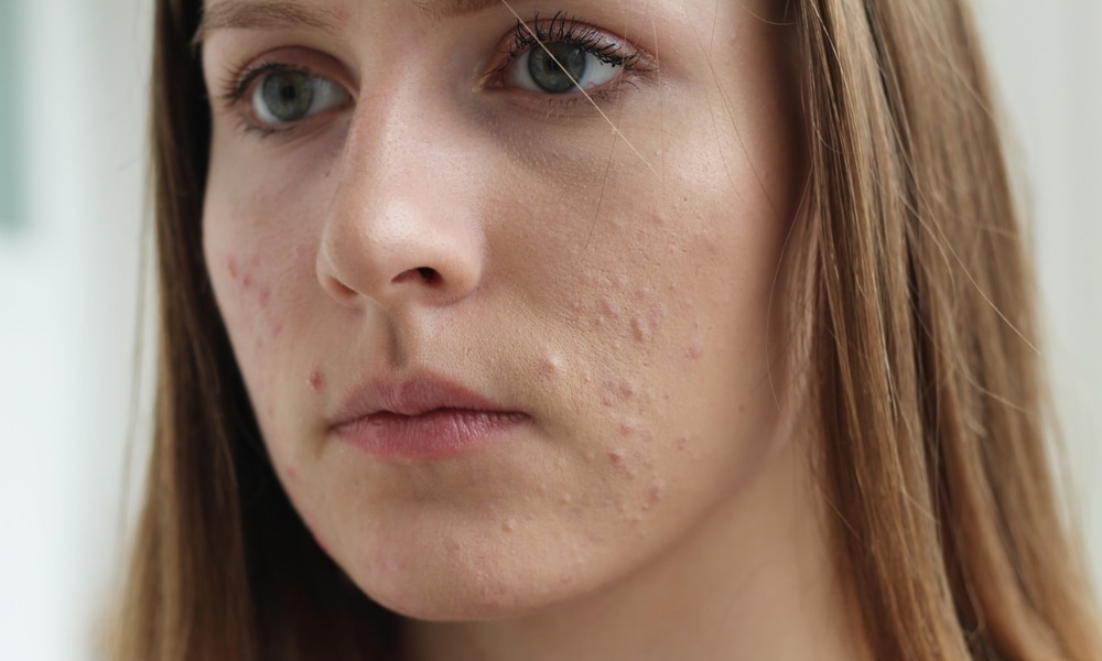 Androcur en dermatologie : quels risques ? - Réalités ...