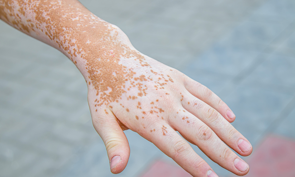 Vitiligo : prise en charge et perspectives thérapeutiques ...