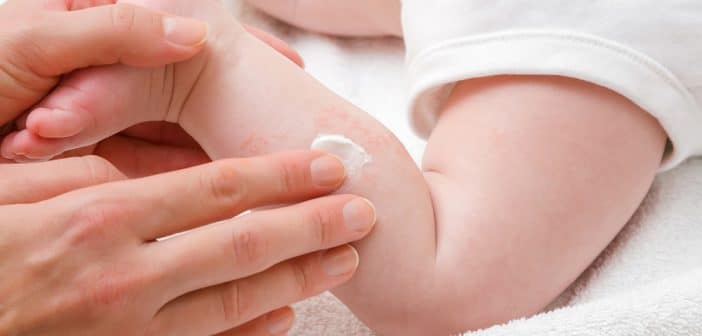 Urticaire de l’enfant