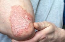 Psoriasis du coude