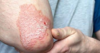 Psoriasis du coude