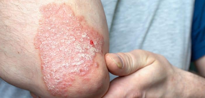 Psoriasis du coude