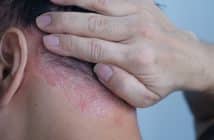 Séquences thérapeutiques dans le psoriasis