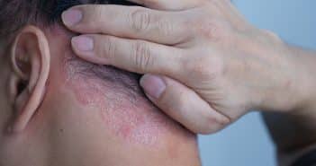 Séquences thérapeutiques dans le psoriasis : impact de la diminution des doses et de l’arrêt des traitements biologiques Séquences thérapeutiques dans le psoriasis
