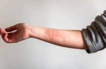 Urticaire chronique spontanée : aspects cliniques et physiopathologiques