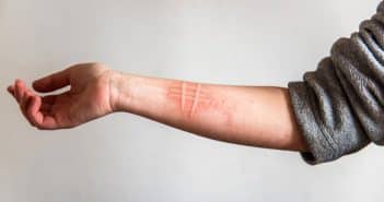 Urticaire chronique spontanée : aspects cliniques et physiopathologiques