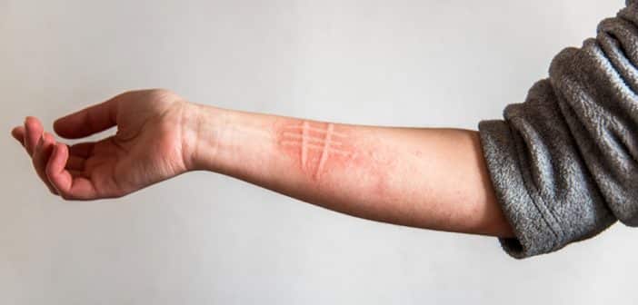 Urticaire chronique spontanée : aspects cliniques et physiopathologiques