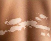 Prise en charge du vitiligo en France : état des lieux et perspectives thérapeutiques