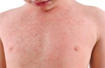 Toxidermie de l'enfant