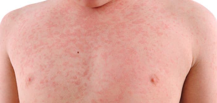 Toxidermie de l'enfant